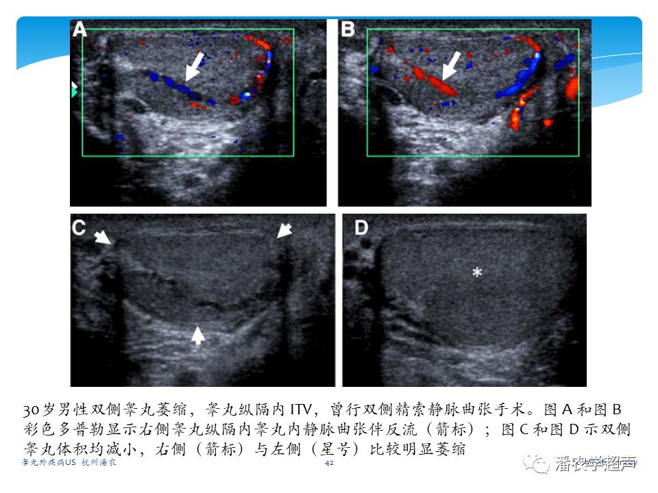 超聲微課堂睪丸外疾病超聲診斷