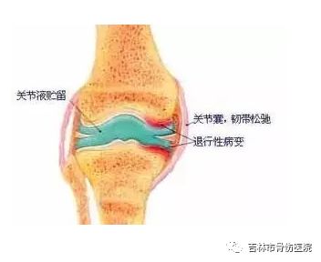 骨性關節炎的臨床表現為關節疼痛,常發生於晨間,活動後疼痛反而減輕