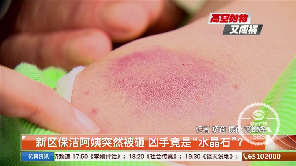 角上砸到人现在变成一大块淤青当时,梁阿姨的肩膀被蹭破了皮巴掌大的