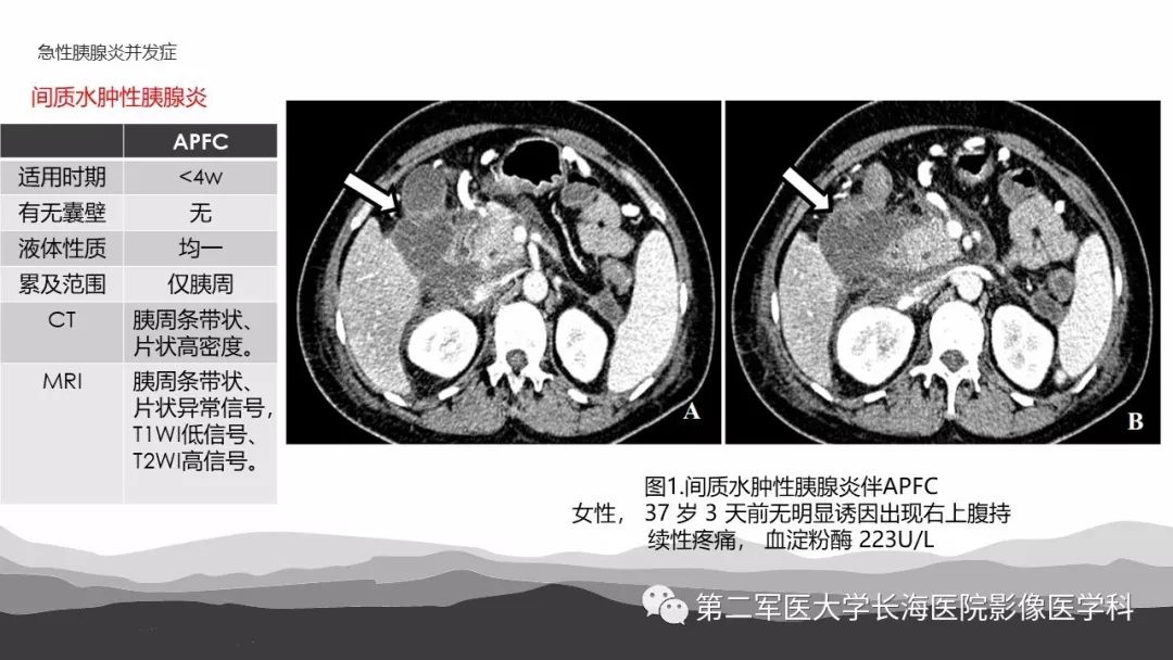 坏死性急性胰腺炎诊断影像治疗