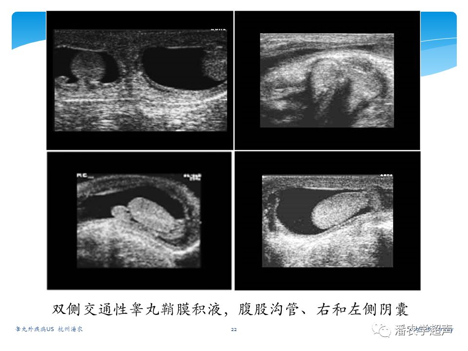超声微课堂睾丸外疾病超声诊断