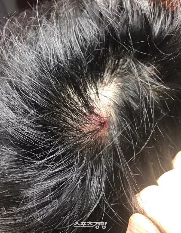 除了这些淤青,甚至还有另一名队员李恩成被用木棒打到头破血流!