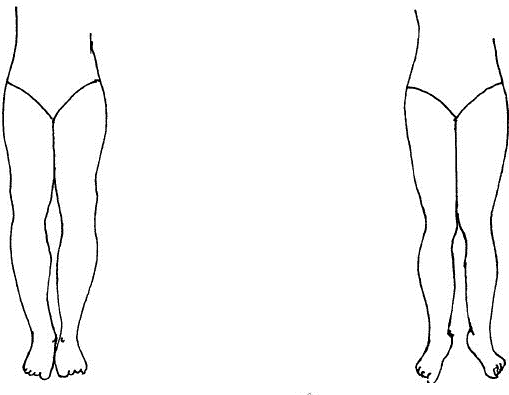 看其双膝处是否能夹紧,如困难,有较大的缝隙即为"o"型腿(罗圈腿)