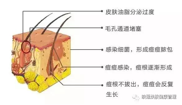 暑假免费祛痘 