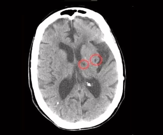 腔隙性脑梗能痊愈吗医生这次终于说清楚了