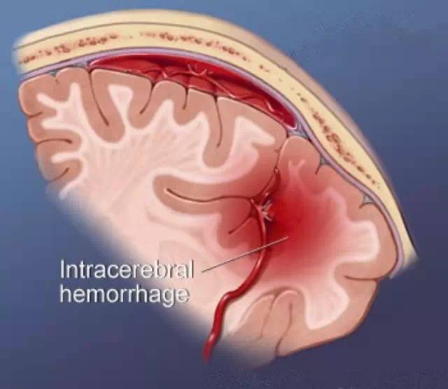 卒中康复脑出血诊疗6大要点