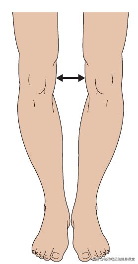 o型腿一般伴随胫骨外旋;x型腿往往伴随胫骨内旋