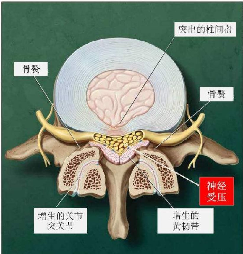 腰椎管狭窄图解图片