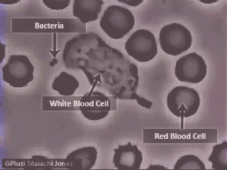 噬肉菌症图片
