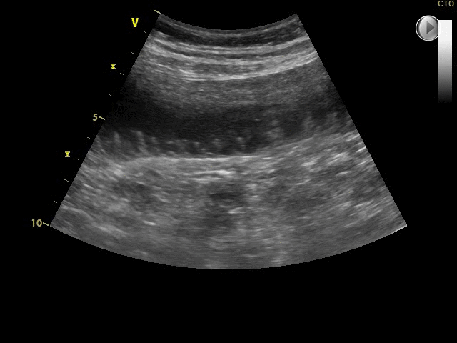 跬步千里frommon重症超声规范5重症胃肠道超声获取与解读