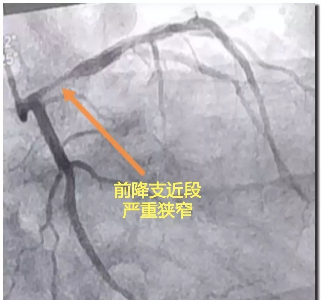 从上火到心肌坏死仅5天识别心梗前兆要牢记这16个字