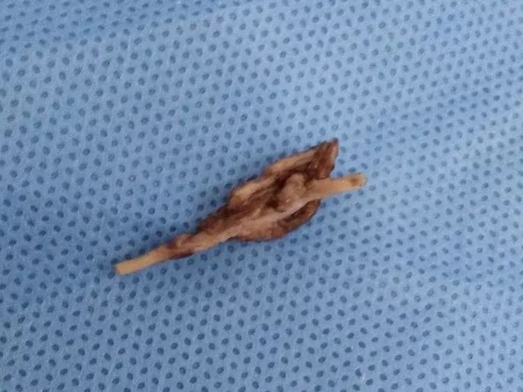 优秀!硕大鸡骨头卡喉寝食难安,医生胃镜下巧取解除痛苦