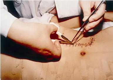 长海心外科:您关心的手术切口方面的几个问题