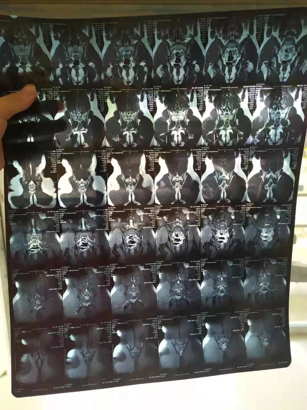 20岁体考生腰部受伤再也不能运动了吗不你能