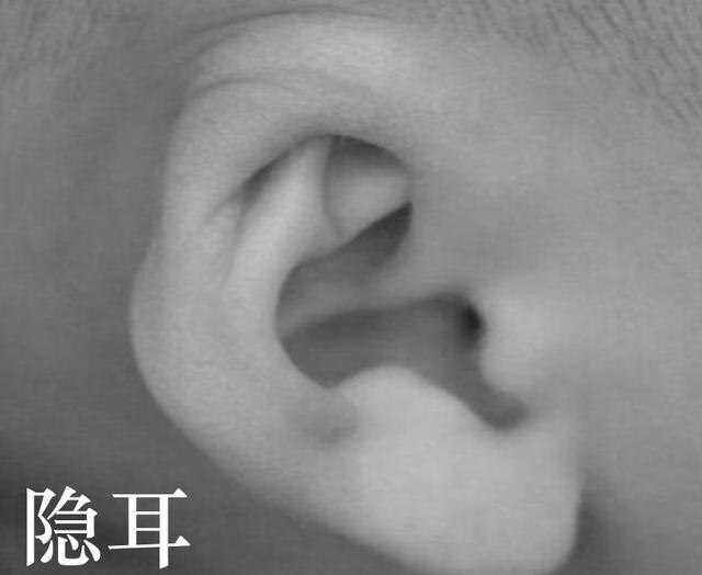 耳廓畸形会影响什么