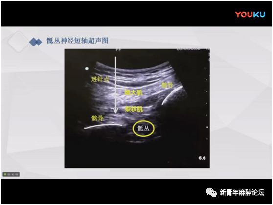由一分钟骶丛阻滞说开去_神经