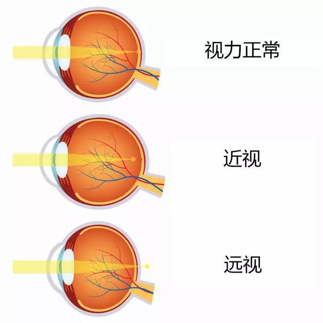 现在近视,以后老花了可以抵消?你想得可真美!_眼睛