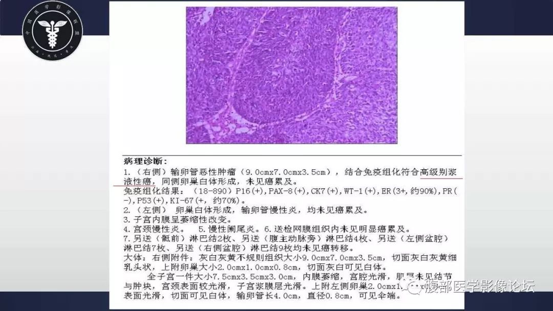 右侧输卵管高级别浆液性癌