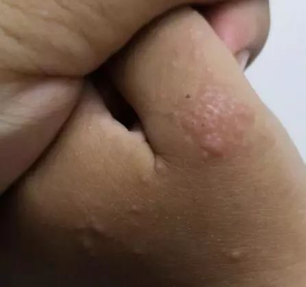 家长当心!宝宝玩沙子也能玩出来「疹子」