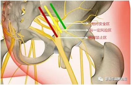 由一分钟骶丛阻滞说开去_神经