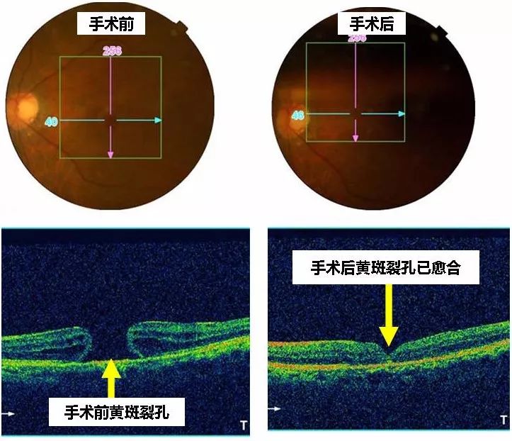 黄斑裂孔如何治疗图片