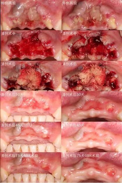7月16至18日【重庆站】口腔种植与咬牙周膜龈手术及种植体周围软硬