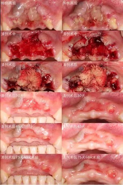 膜龈手术图片