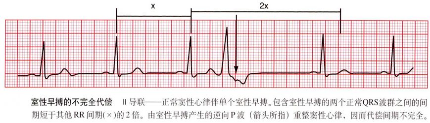 st-t呈继发性改变(即室早的t波与qrs波群主波方向相反)