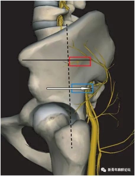 骶丛神经阻滞图片