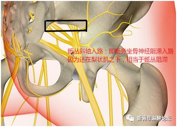 由一分钟骶丛阻滞说开去_神经