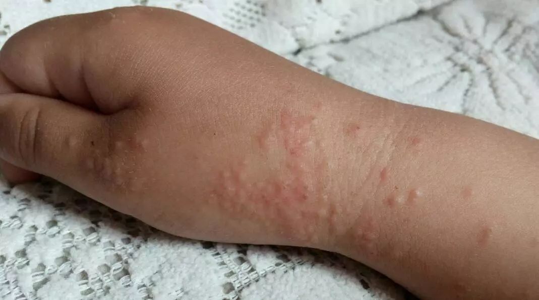 沙土皮炎又叫青少年丘疹性皮炎, 摩擦性苔藓样疹等,是夏秋季节儿童