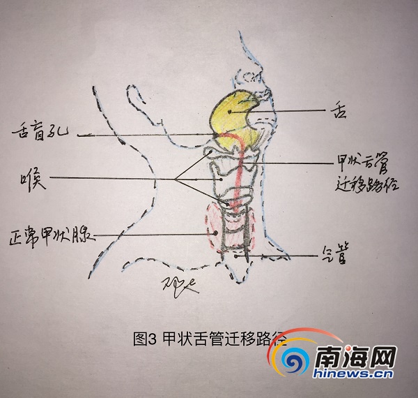 舌根部长了小舌头图片图片