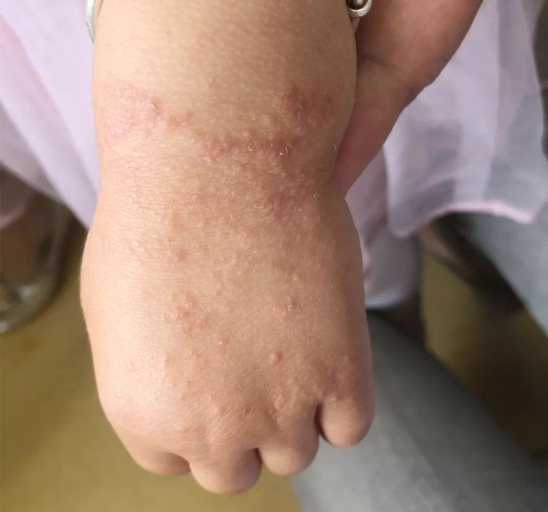 沙土皮炎每个孩子都会出现的皮肤病