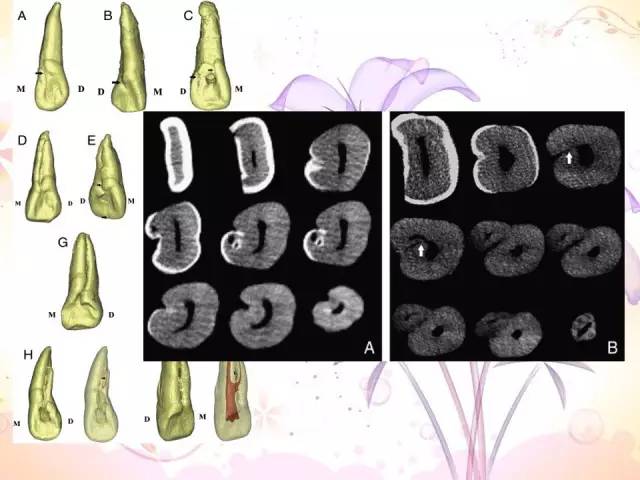 畸形舌侧沟临床对策