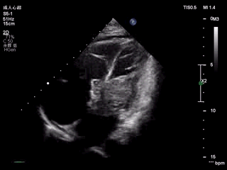 正常4条肺静脉超声图图片