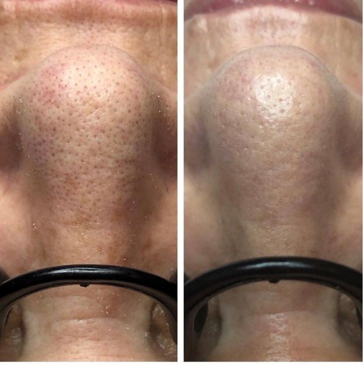 深圳医美团|花30分钟与黑头说再见!_皮肤