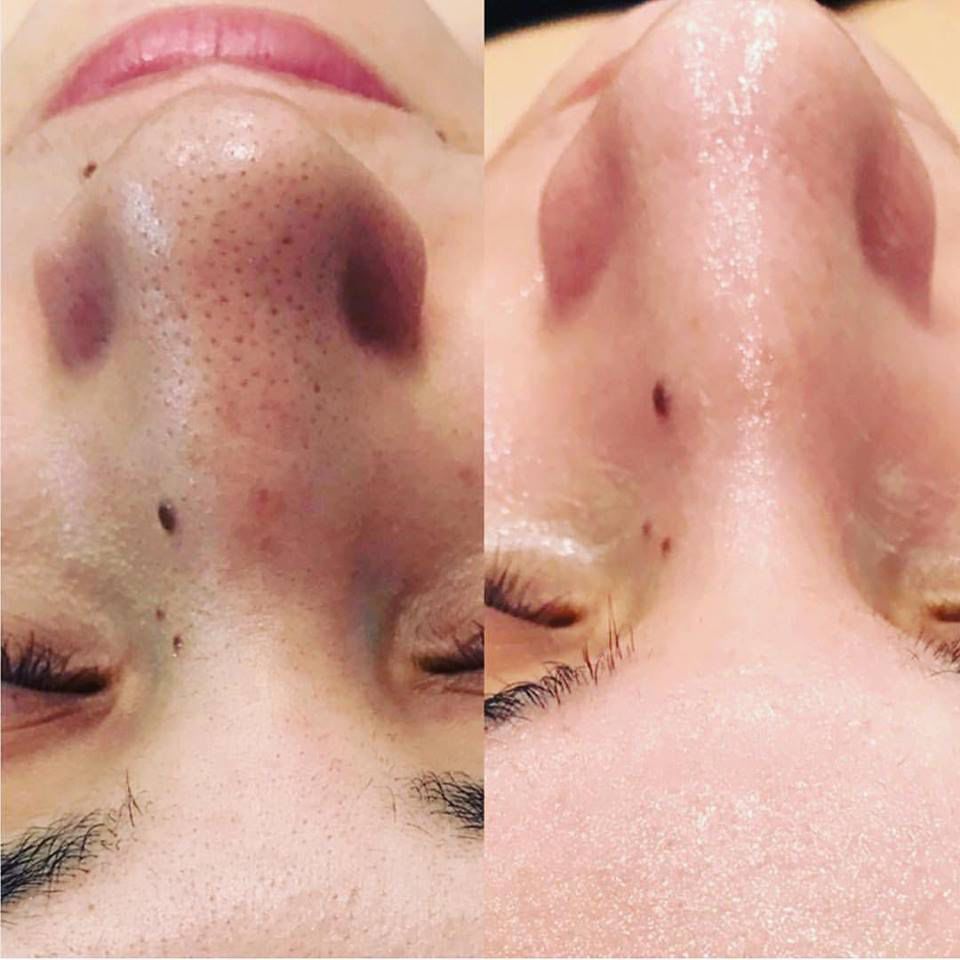 深圳医美团|花30分钟与黑头说再见!_皮肤