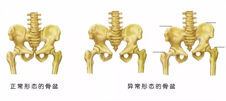 很可能是这里出了问题_骨盆