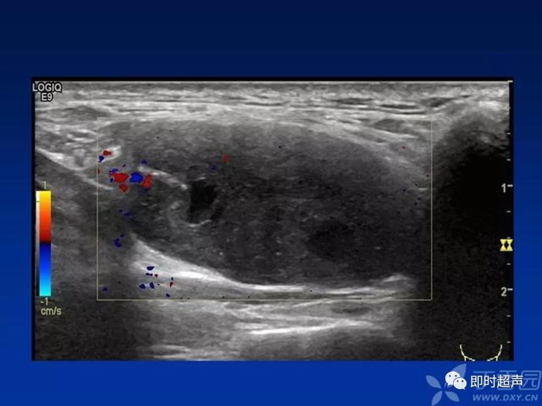 体表肿物的超声诊断与鉴别