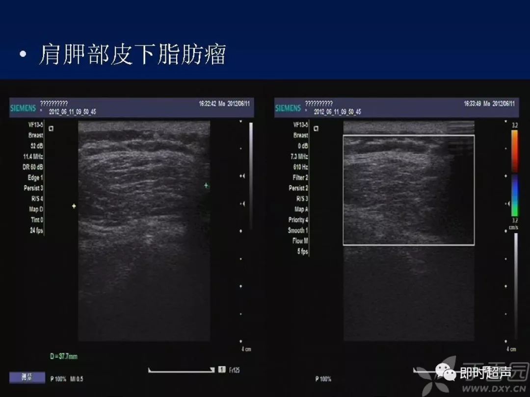 体表肿物的超声诊断与鉴别