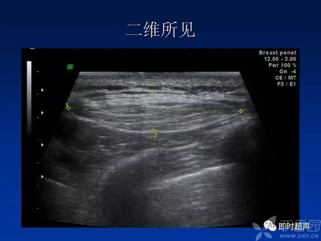 体表肿物的超声诊断与鉴别