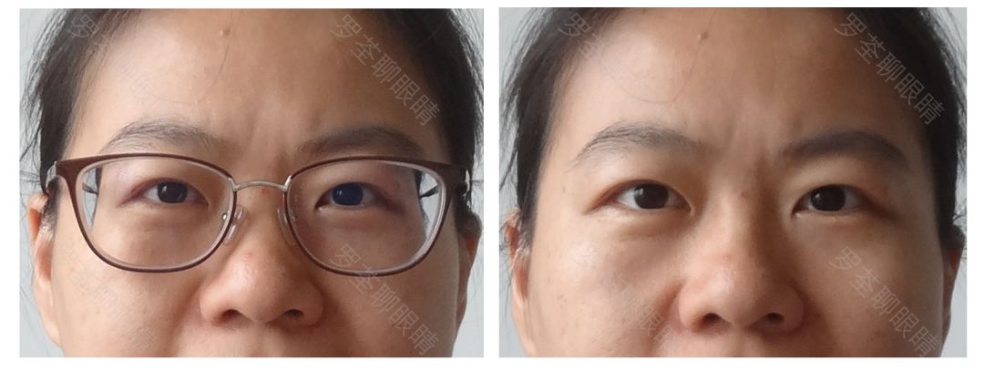 戴近视眼镜后,真的会「变丑」?眼科医生坐不住了