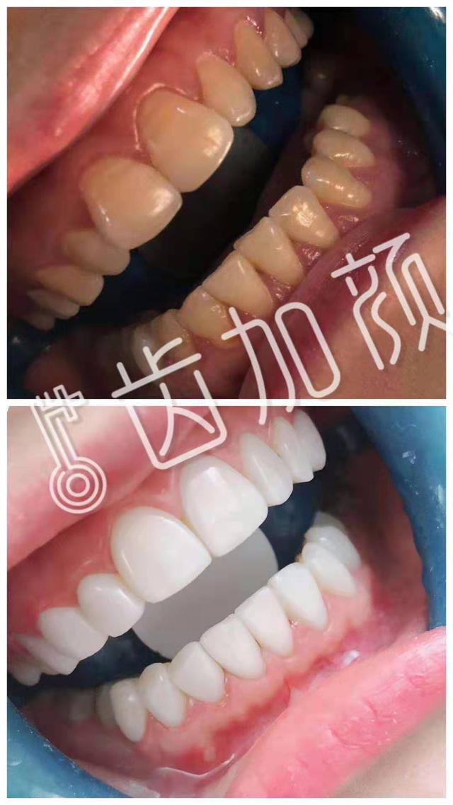 类瓷美牙贴面的原理是什么?