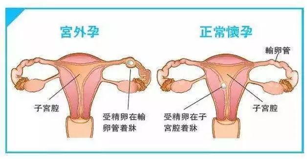 宫外孕患者阴道出现不规则的出血,多为点滴状,深褐色,量少,没有月经量