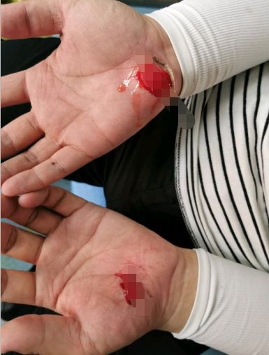 合肥一男子骑共享单车出车祸双手皮开肉绽鲜血淋淋