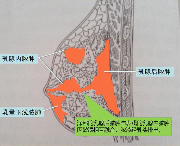 马伊琍9个月得3次急性乳腺炎:后悔没早了解它!