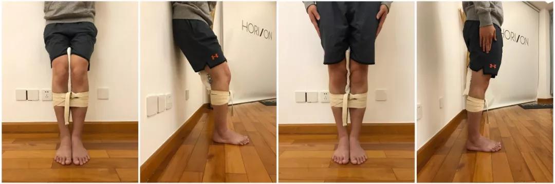 长腿小姐姐的5天o型腿矫正案例