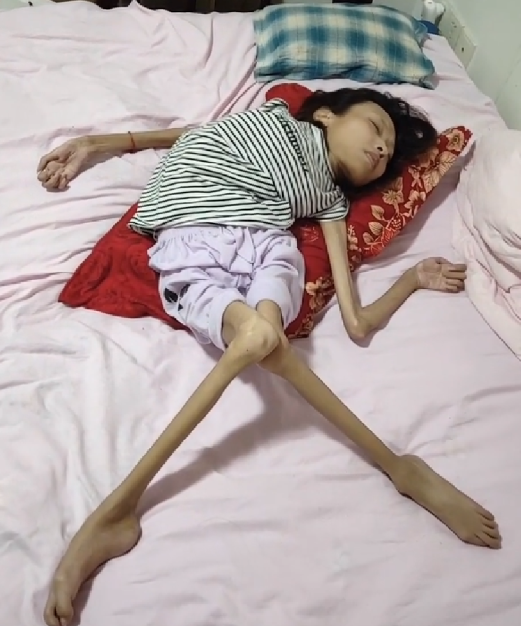 32岁女网红30斤体重肌肉还严重萎缩却嫁了个爱他的男人是真爱