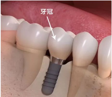 牙冠是啥图片