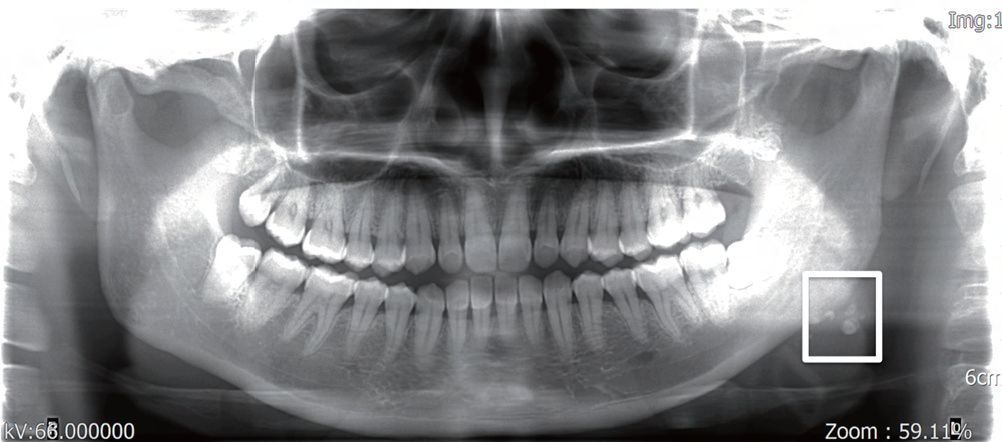 牙曲面断层片图片